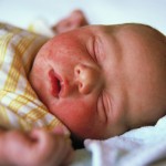 Причины возникновения акне младенцев 