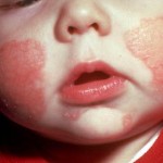 Аллергическая сыпь у детей. Лечение